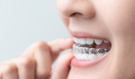 Patient putting on clear aligner