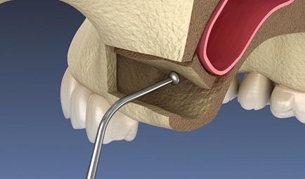 Illustration of tool moving sinus membrane during sinus lift