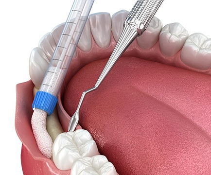 Illustration of a bone graft
