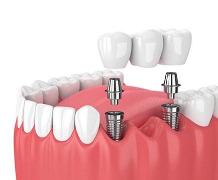 illustration implant dental bridge in Baltimore