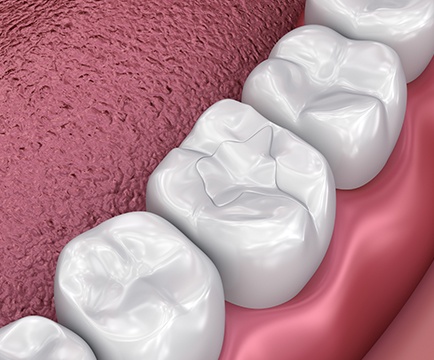 Animated smile after metal free dental restorations