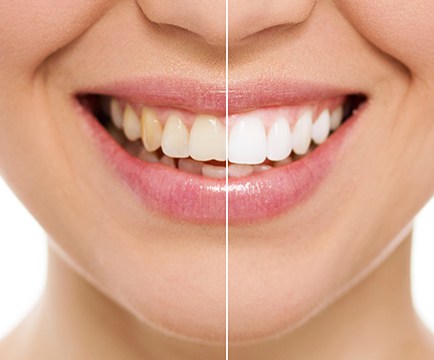 Woman's smile before and after teeth whitening