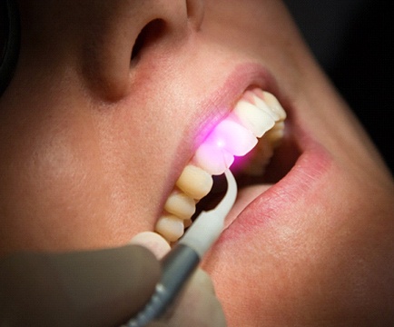 Dentist using dental laser