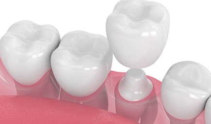 3D render of a dental crown