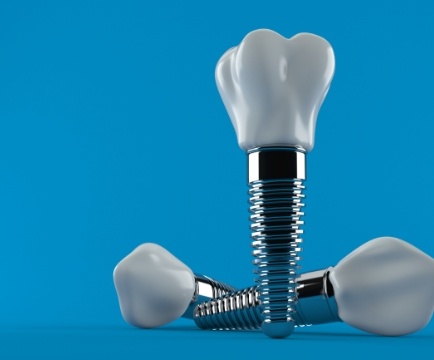 Three animated dental implant supported replacement teeth