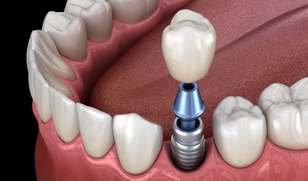 Animated dental implant supported dental crown placmeent