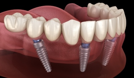 Animated dental implant supported denture placement