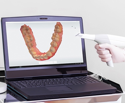 Digital smile impression systems