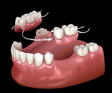 Partial dentures replacing five teeth on lower arch