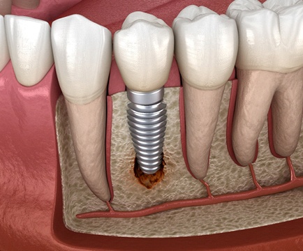 Illustration of peri-implantitis, a cause of dental implant failure