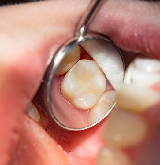 Closeup of a tooth reflected in dental mirror