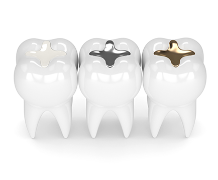 Illustration of a tooth-colored filling next to silver and gold fillings