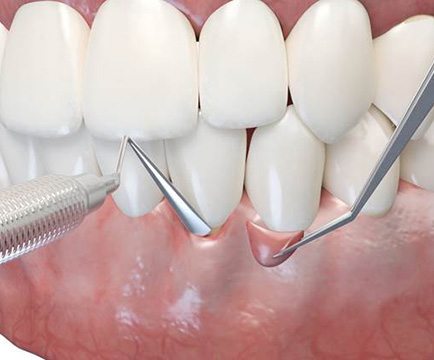 Illustration of tissue being grafted onto patient’s gums