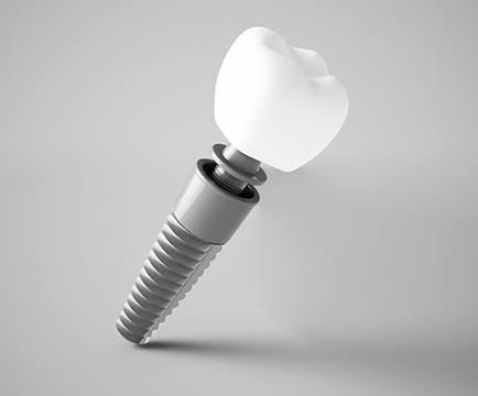 Diagram showing different parts of a dental implant in Baltimore 