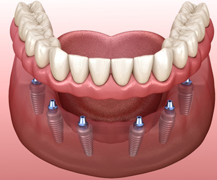 Illustration of implant dentures