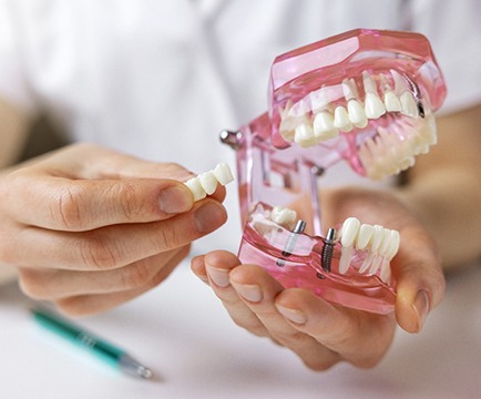 A dentist using a model to explain how implant dentures work
