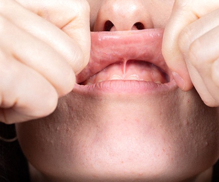 Closeup of man with lip-tie in Baltimore