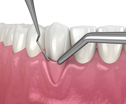 Animated smile during gum grafting treatment