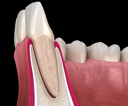 Animated smile following osseus surgery