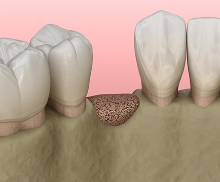 Animated smile after bone grafting