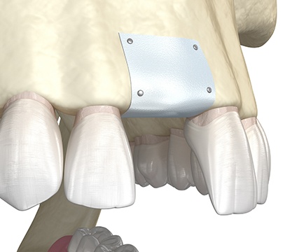 Animated smile after ridge preservation