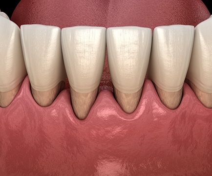 Patient with advanced gum disease