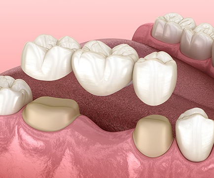 Animated dental bridge placement