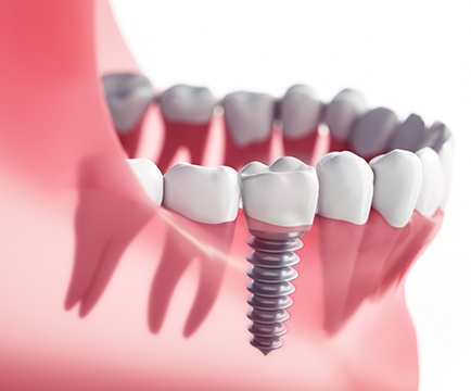 Animated dental implant supported replacement tooth
