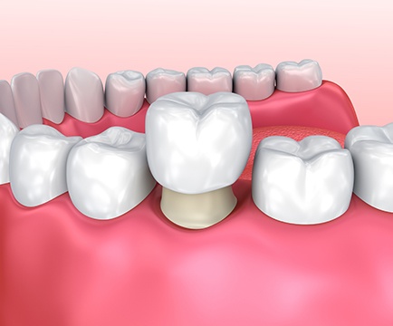 Animated dental crown placement