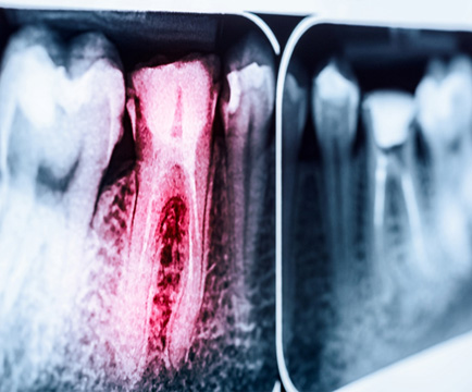 an X-ray of a molar in Baltimore