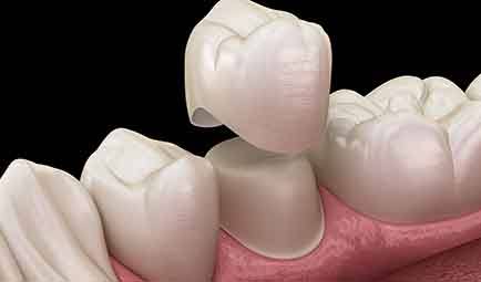 Digital image of a root canal being performed