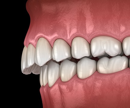 Animated smile in need of occlusal adjsutment