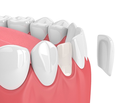 Model of veneer being placed on lower arch of teeth