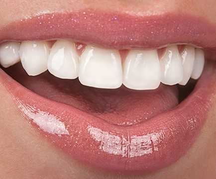 Close-up of a woman’s smile with porcelain veneers