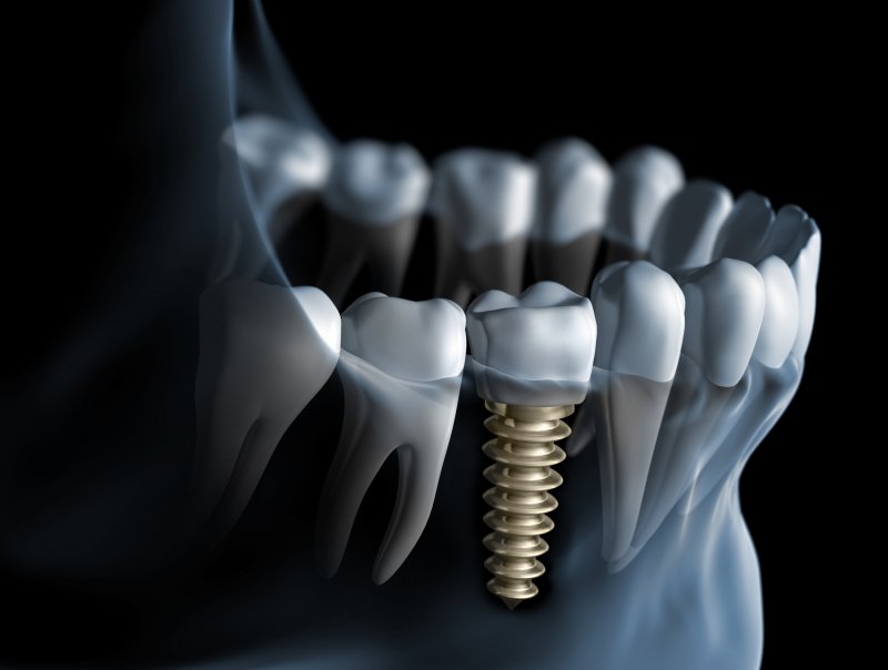 Dental implant in Baltimore