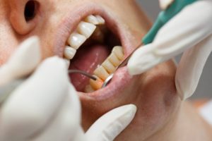 Dentist performing crown lengthening in Baltimore