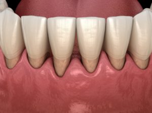 Model of exposed tooth roots