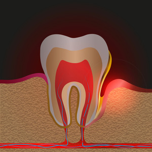 Illustration of a periodontal pocket