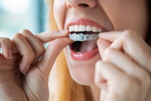 Woman putting clear aligners over teeth. 