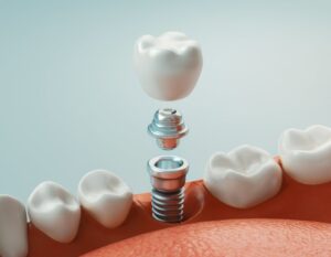Rendering of dental implant.