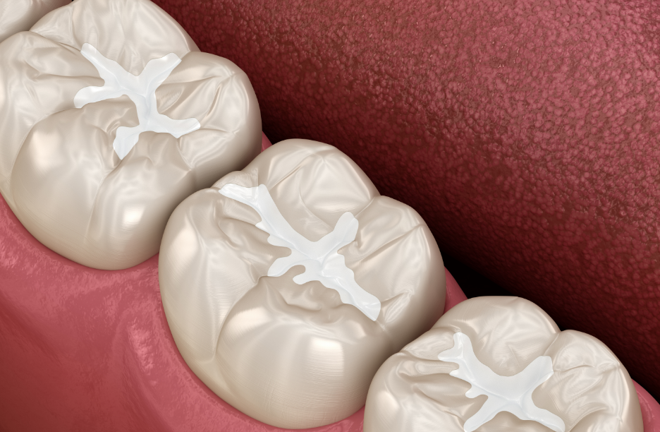 3D image of dental fillings